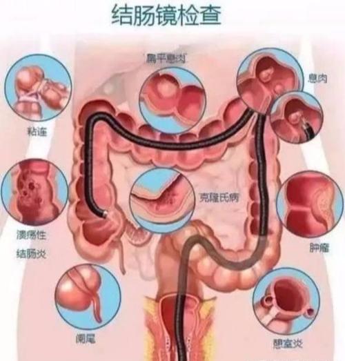 结肠癌的早中晚期的症状和表现_结肠癌的早中晚期的症状和表现是什么