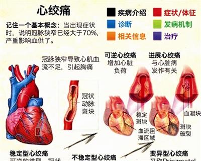 冠心病早期症状_冠心病早期症状和前兆