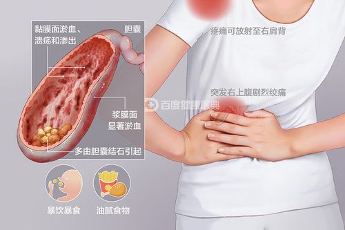 胰腺炎是什么症状 哪个位置痛_胰腺炎的症状是哪里疼