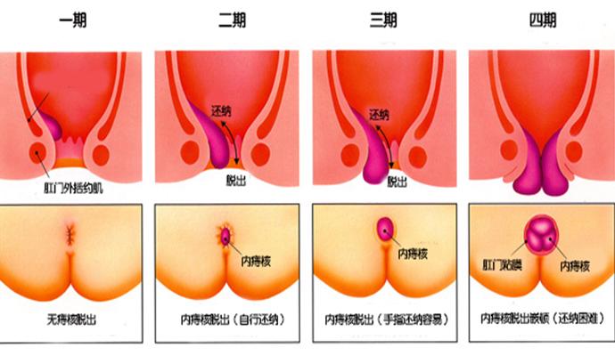 痔疮的症状图片_痔疮的症状图片,痔疮图片大全