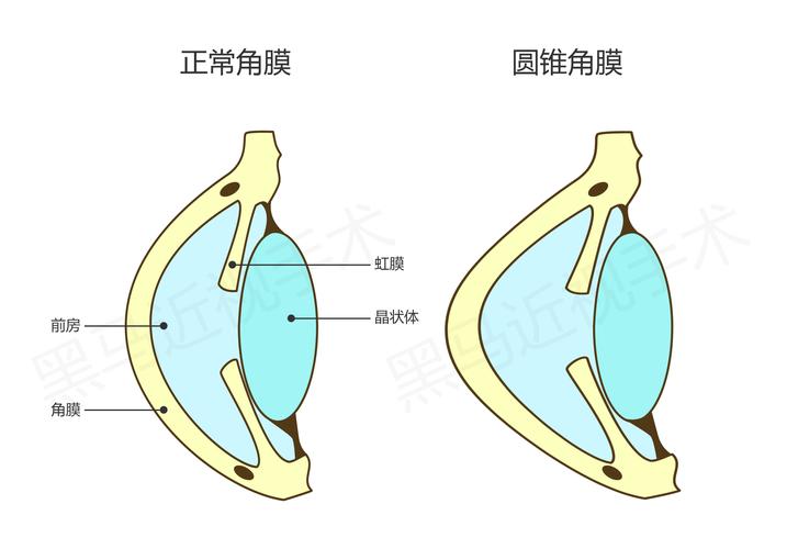 圆锥角膜_圆锥角膜能治好吗