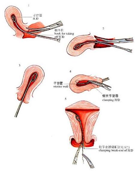 女人带环过程_女人带环过程需要多久?