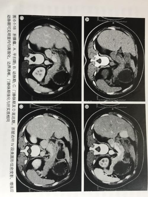 肝腺瘤_肝腺瘤是什么意思,严重吗