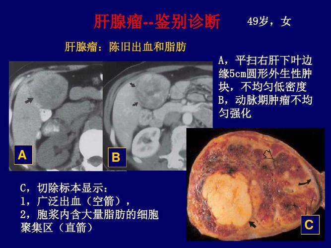 肝腺瘤_肝腺瘤是什么意思,严重吗