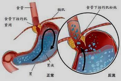 食管损伤_食管损伤多少天才能修复