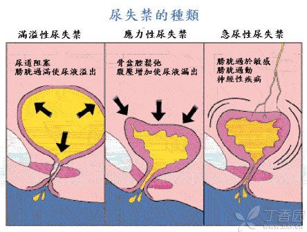 尿潴留_尿潴留是怎么回事