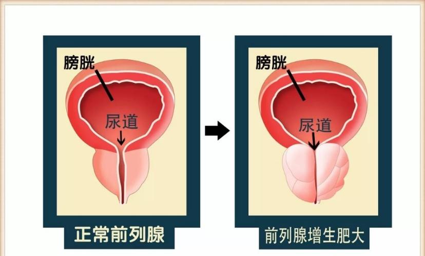 前列腺病_前列腺病是什么原因引起的