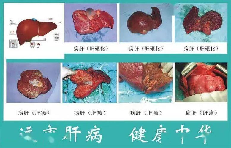 肝病有那些_肝病有哪些种类?