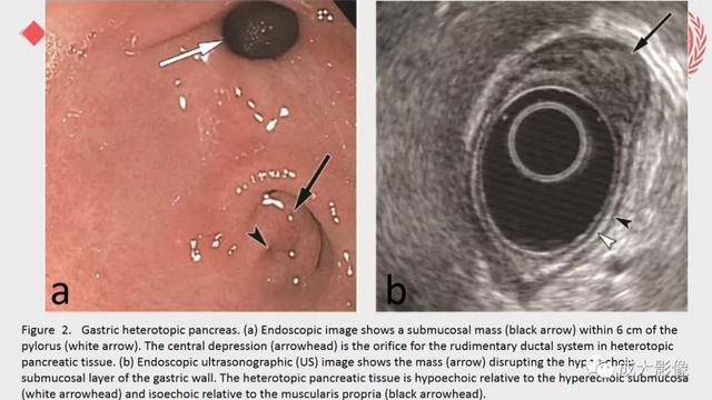 异位胰腺_异位胰腺是什么样的一种疾病