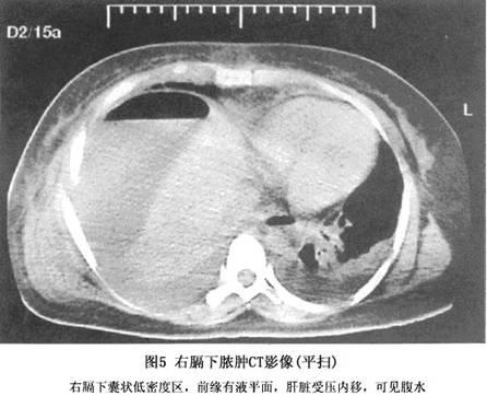 膈下脓肿_膈下脓肿最典型的症状