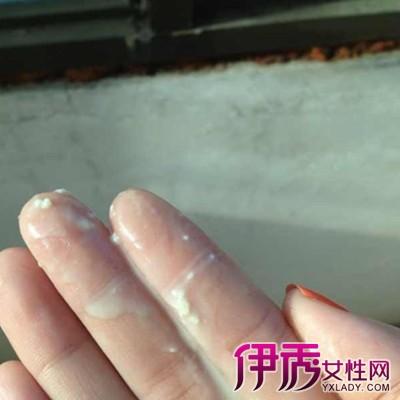 豆渣样白带_女生下面白色豆腐渣可自愈吗