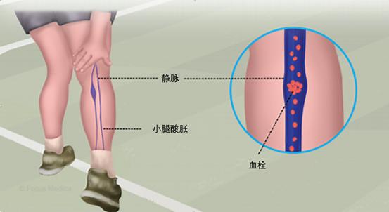 小腿_小腿酸胀痛什么原因引起的