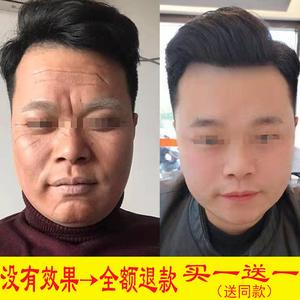 抬头纹怎么去_抬头纹怎么去除最有效男生