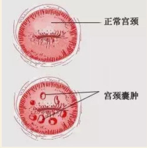 宫颈囊肿图片_宫颈囊肿图片 清晰图片