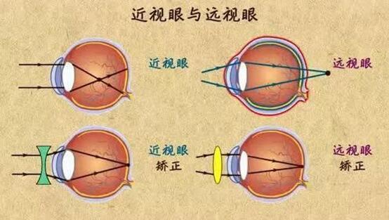 远视眼_远视眼是怎么回事