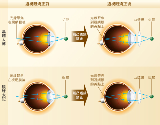 远视眼_远视眼是怎么回事