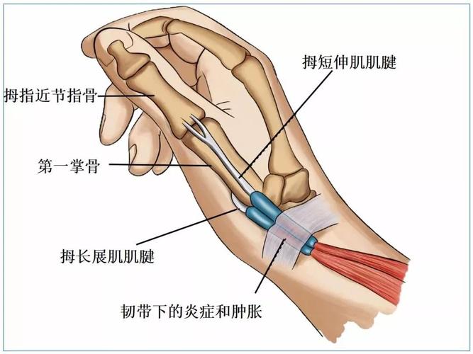 腱_腱鞘炎发生部位图片