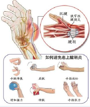 腱_腱鞘炎发生部位图片