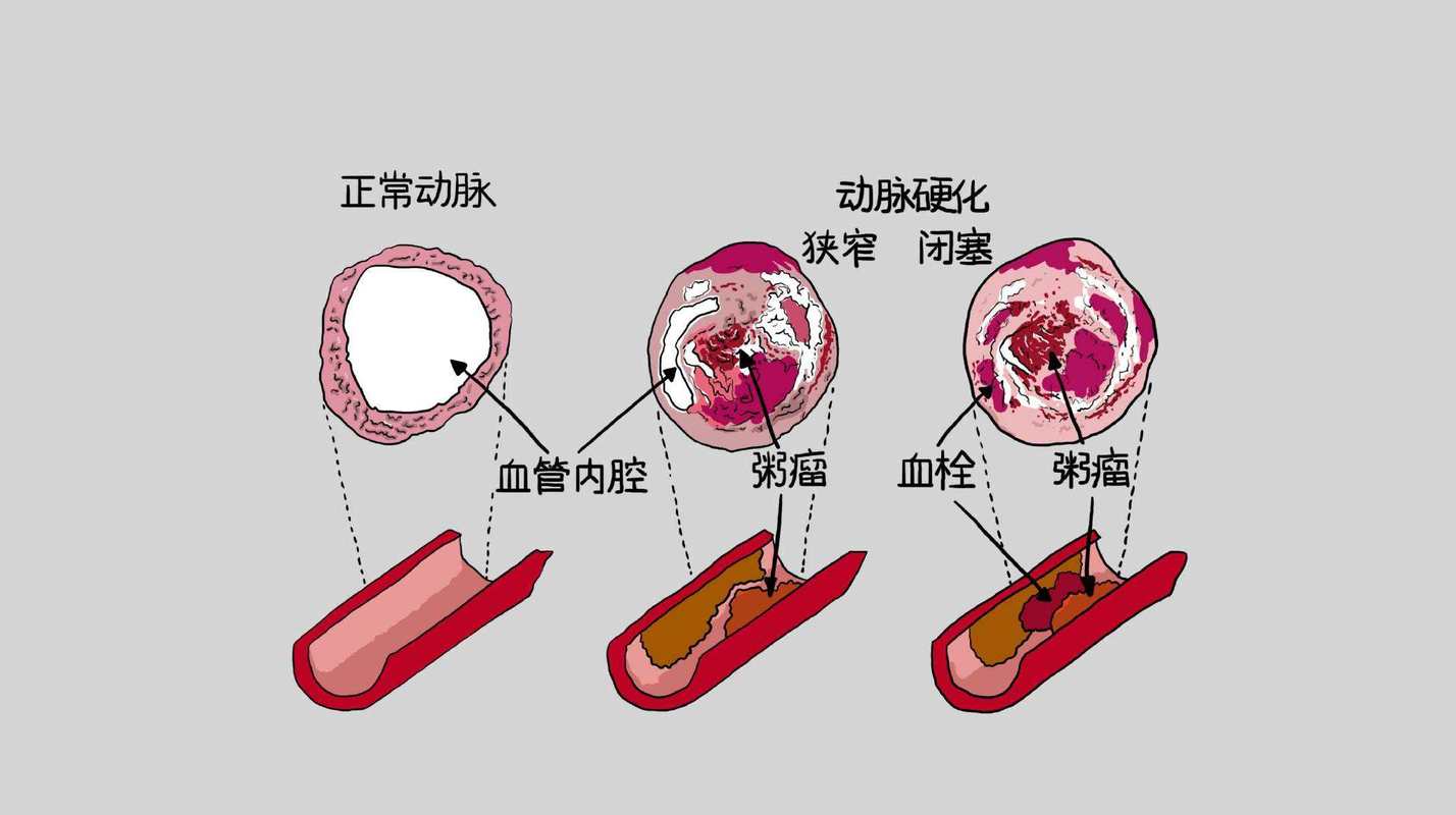 动脉硬化_动脉硬化怎么治疗最好的方法