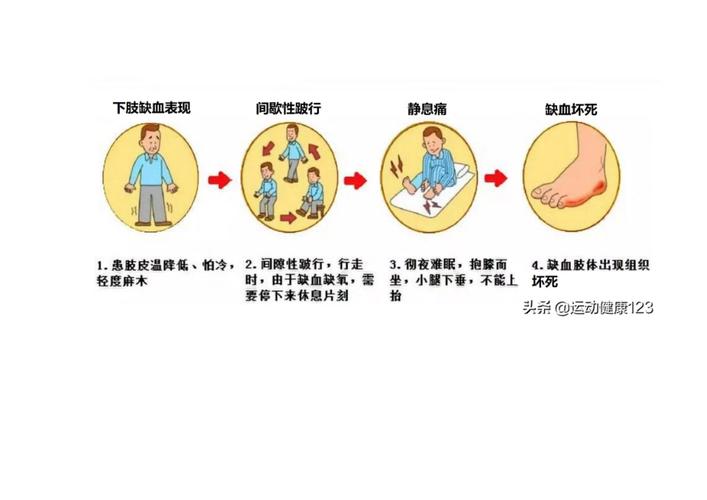 动脉硬化_动脉硬化怎么治疗最好的方法