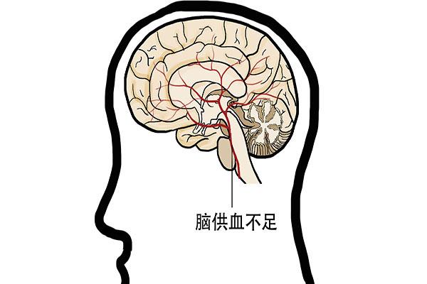 脑供血不足的原因_脑供血不足的原因是什么引起的