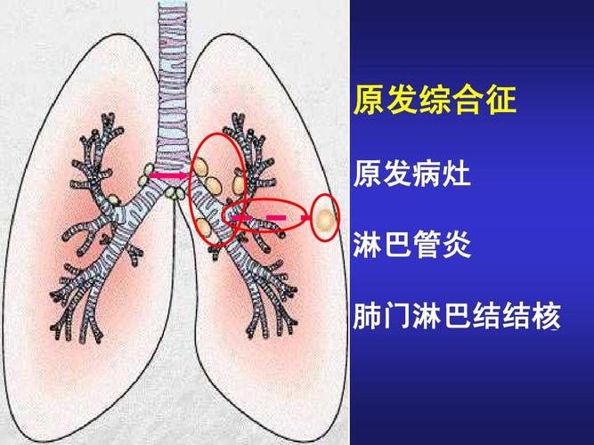 肺门淋巴结核_小儿肺门淋巴结核