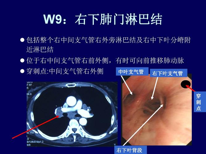 肺门淋巴结核_小儿肺门淋巴结核