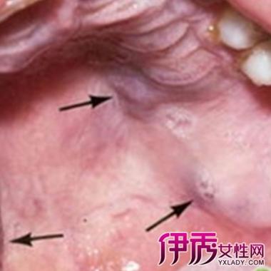 艾滋病口腔_艾滋病口腔症状图片