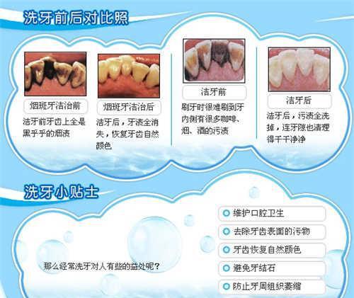 超声波洗牙_超声波洗牙一次多少钱