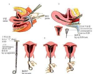 节育环的原理_节育环的原理是什么