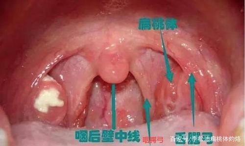 扁桃体肿大怎么办怎样才能消下去_孩子扁桃体肿大怎么办怎样才能消下去