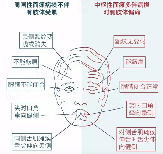 小儿面瘫_小儿面瘫是怎么引起的