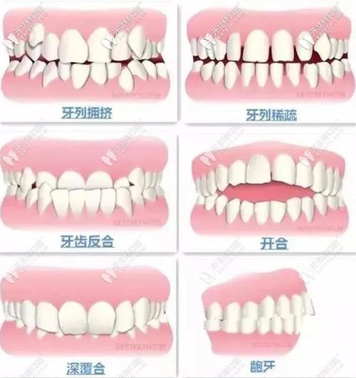 矫正牙齿的危害_矫正牙齿的危害有哪些