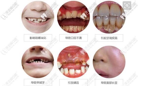 矫正牙齿的危害_矫正牙齿的危害有哪些