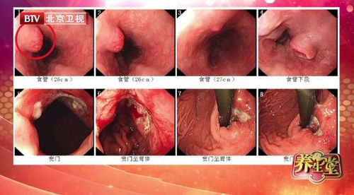 胃癌早期有什么症状_胃癌早期有什么症状或前兆