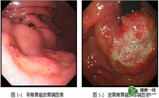 胃癌早期有什么症状_胃癌早期有什么症状或前兆