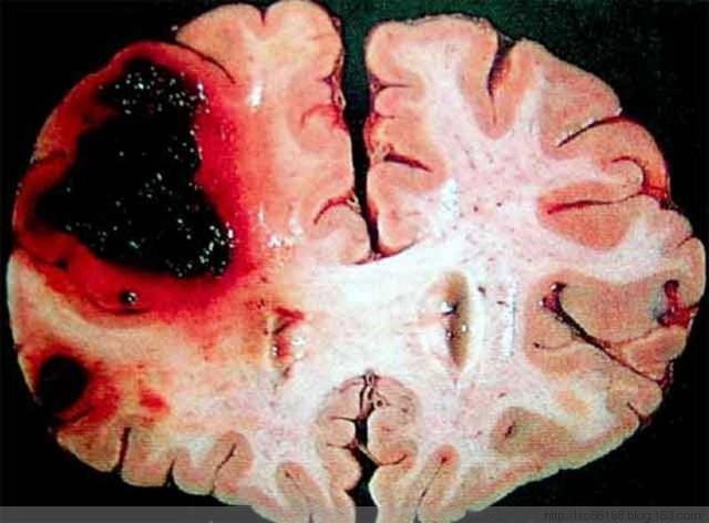 脑溢血的症状_脑溢血的症状都有哪些前期症状