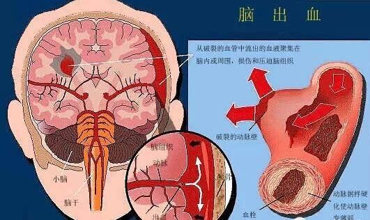 脑溢血的症状_脑溢血的症状都有哪些前期症状