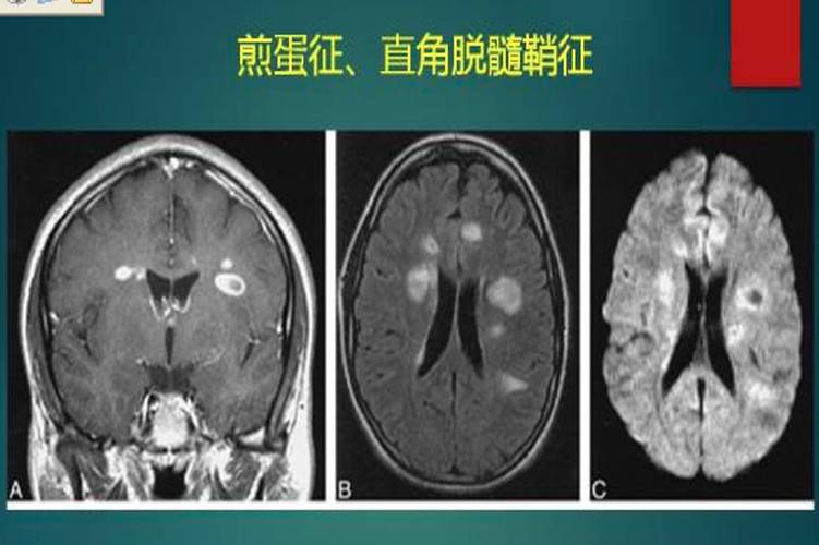 多发性脑梗塞_多发性脑梗塞是啥意思