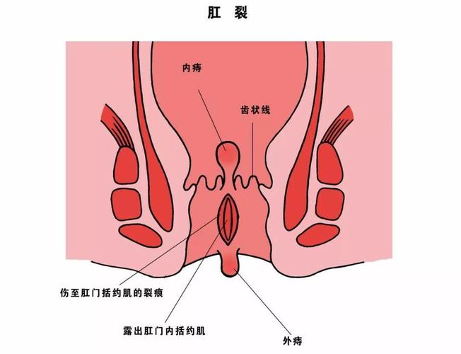 正常屁眼图与痔疮图片_正常肛门痔疮图片