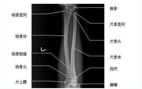 桡骨是哪个部位图片_手腕桡骨是哪个部位图片