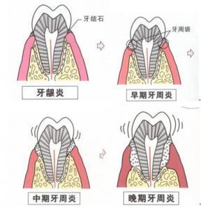 牙神经痛怎么办_牙神经痛怎么办立刻止疼妙绝招