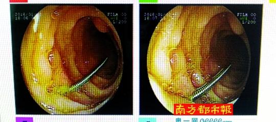 男婴针灸误吞钢针_男婴针灸误吞钢针怎么办