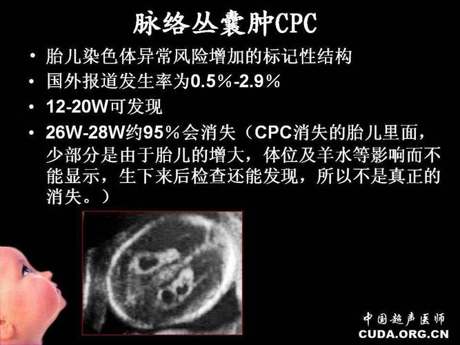 脉络丛囊肿_脉络丛囊肿是什么意思