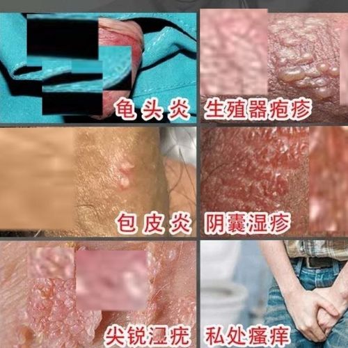 性病能治愈吗_男性得了性疾病能治好吗