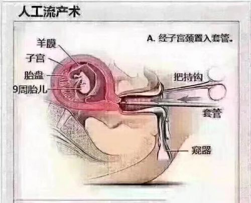 人工流产痛吗_人工流产痛吗有多痛