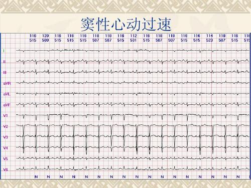 心电图窦性心动过速_心电图窦性心动过速是什么意思