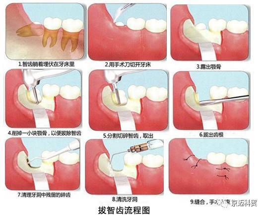 漱口水的正确使用方法_拔完智齿漱口水的正确使用方法