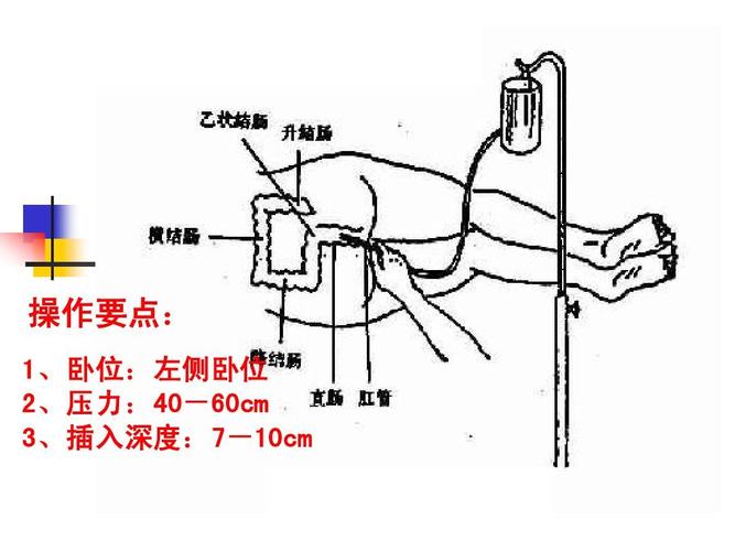 灌肠_灌肠通便怎么操作方法