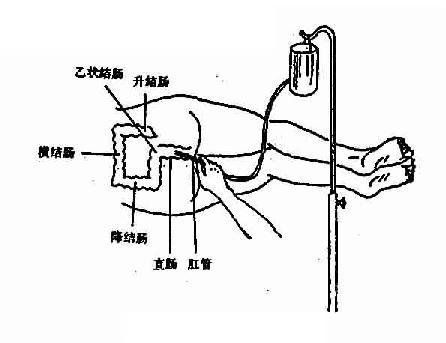 灌肠_灌肠通便怎么操作方法